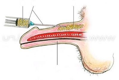 Инъекциялық пениспен кеңею